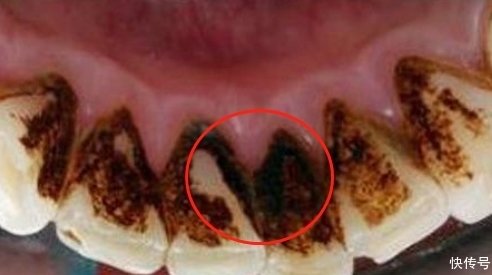 牙缝里的"黑垢"有臭鸡蛋味儿?牙医:别乱扣,学一招牙垢自己掉