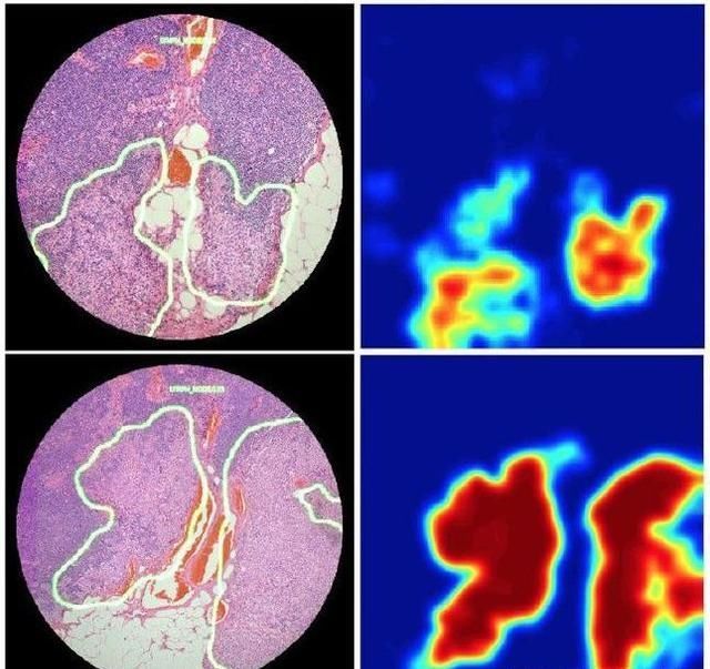肿瘤癌细胞增殖速率有多大?担忧复发转移病友们应知晓的底细